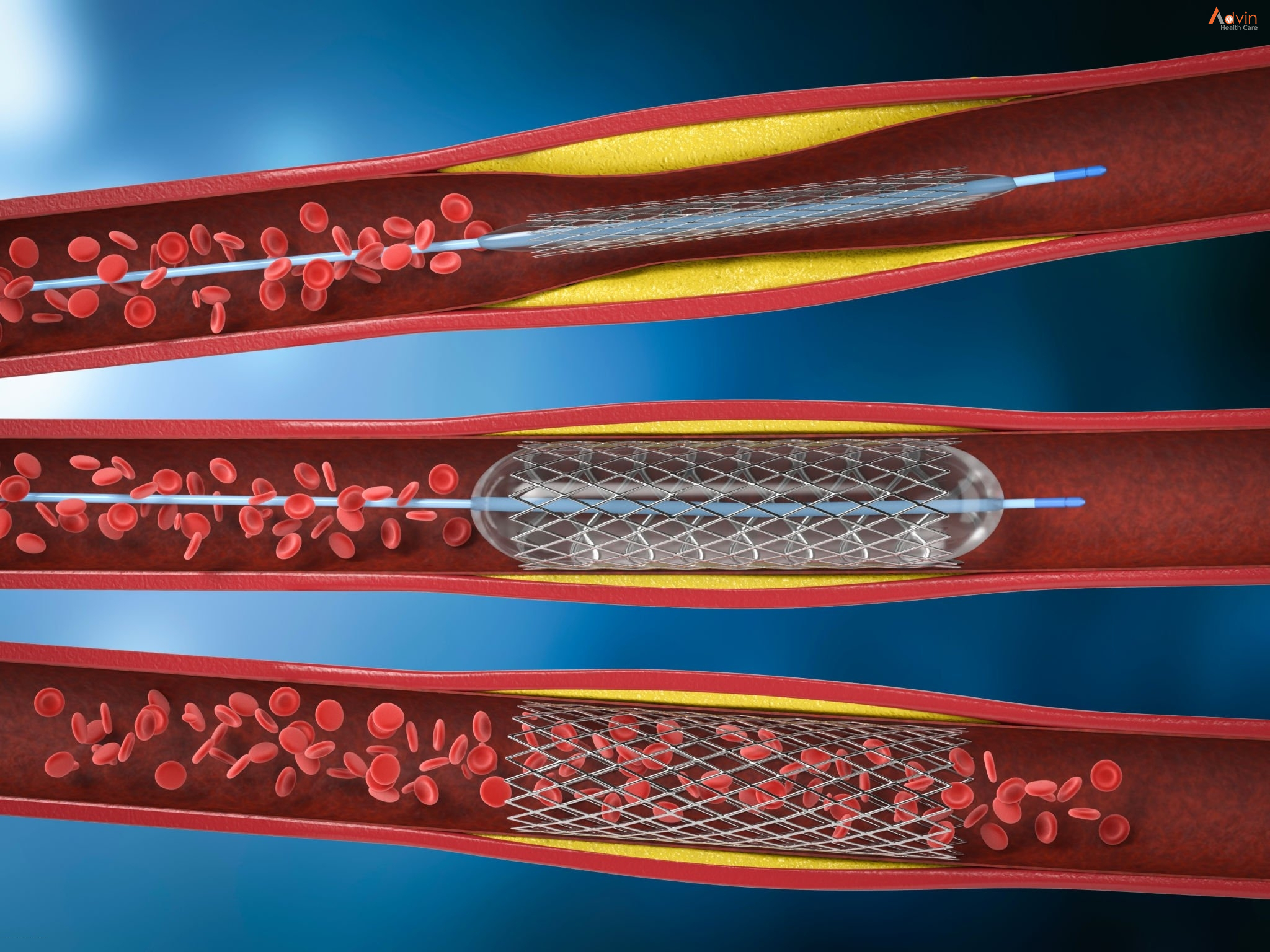 Heart Attack and Sudden Cardiac Arrest Differences – AdvinHealthcare %