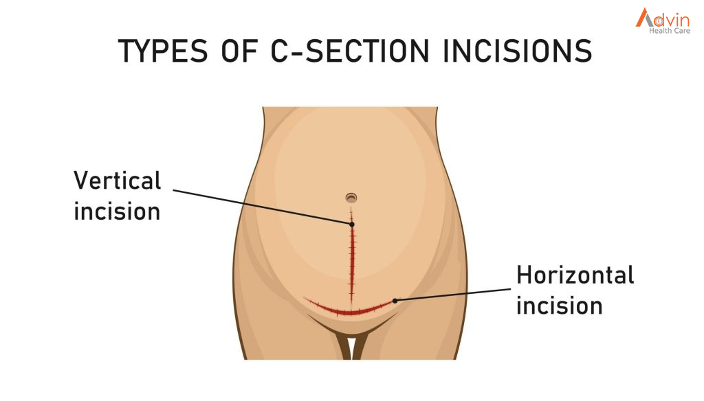 C-Section Surgery Or Cesarean Delivery – AdvinHealthcare %