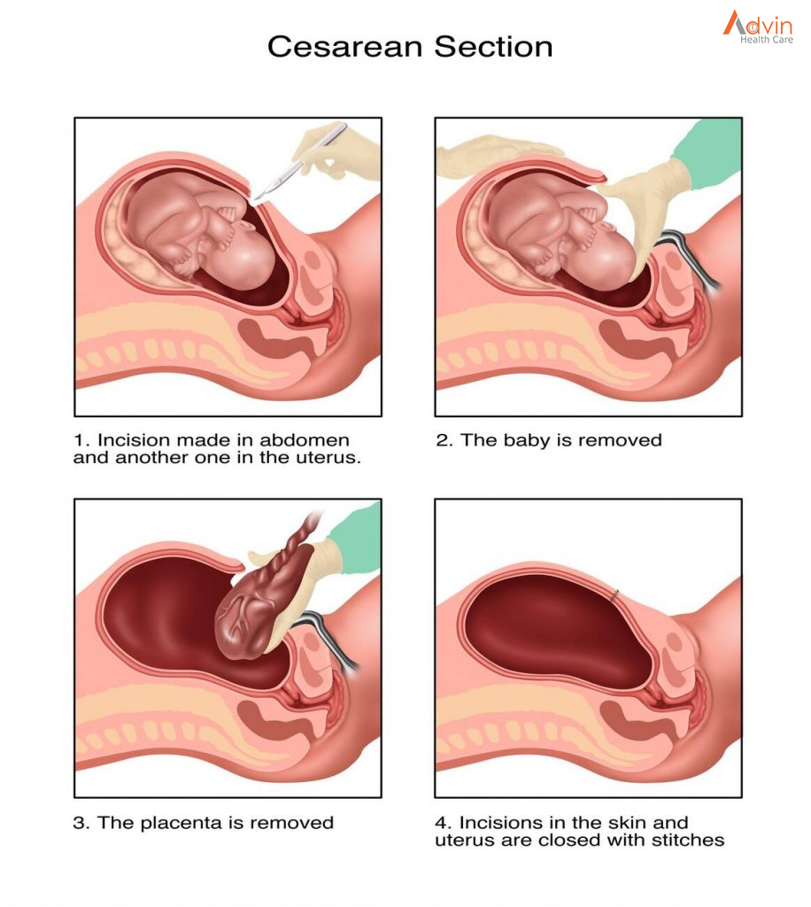 C-Section Surgery Or Cesarean Delivery – AdvinHealthcare %