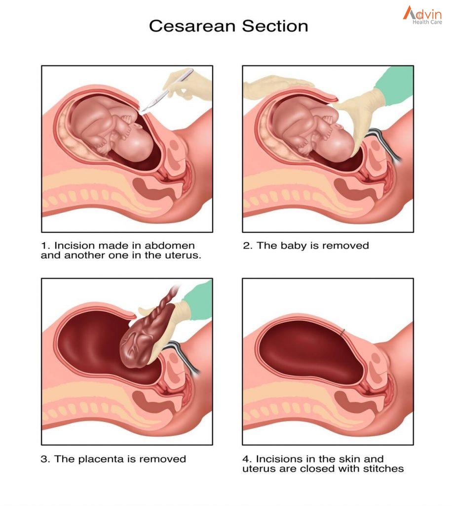 Cesarean delivery