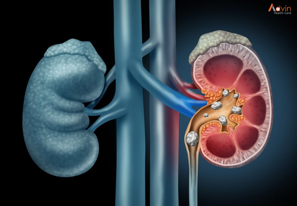 Definition & Facts For Kidney Stones