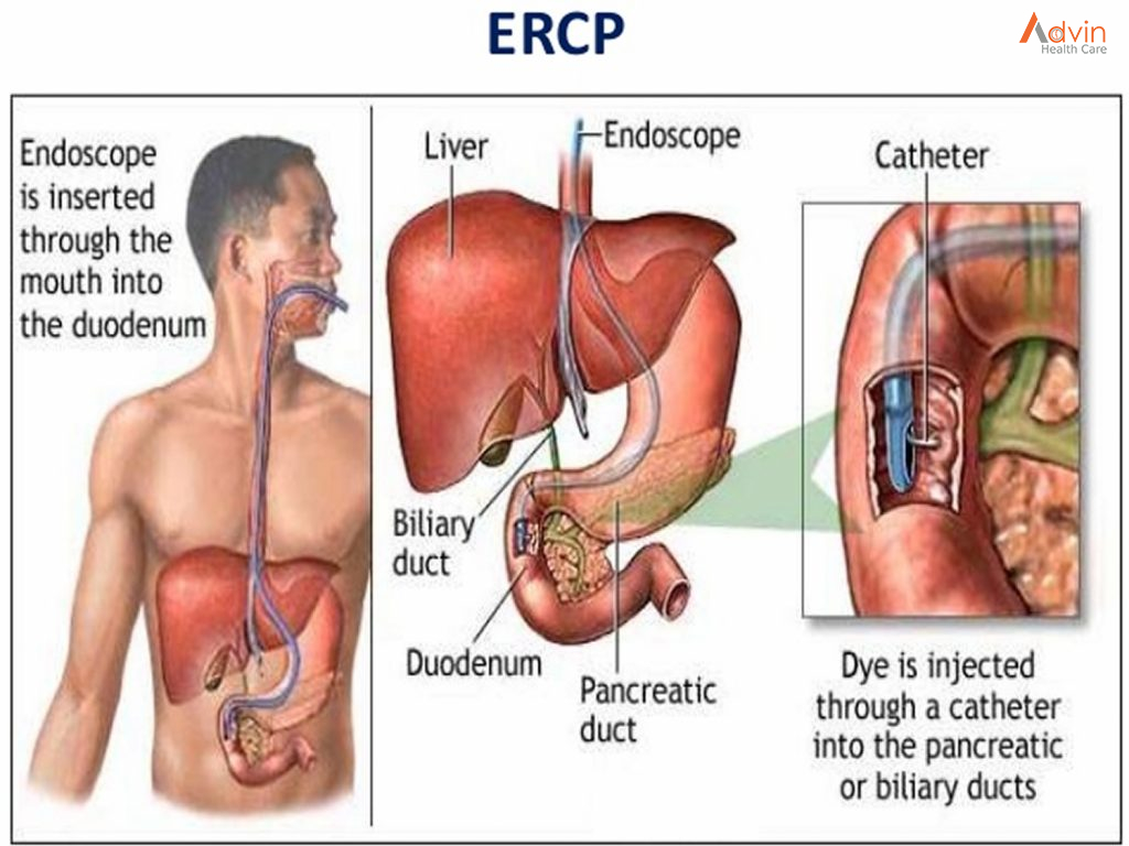 ERCP: What It Is, Why It's Done, Procedure & Complications