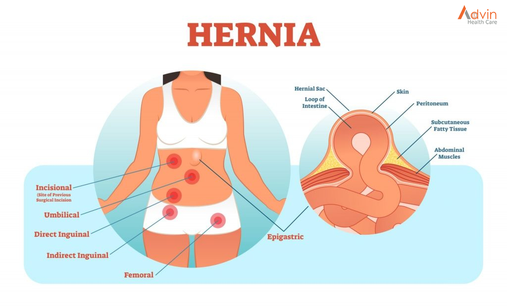 Hernia Repair - Northern Light Health