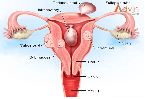 Vaginal Hysterectomy Surgery – AdvinHealthcare %