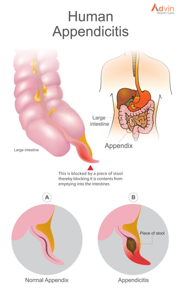 Heart Attack and Sudden Cardiac Arrest Differences – AdvinHealthcare %