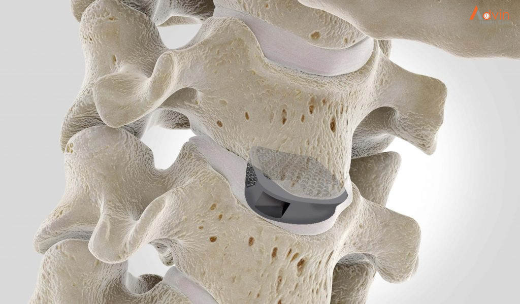 ACDF (Anterior Cervical Discectomy And Fusion) Surgery