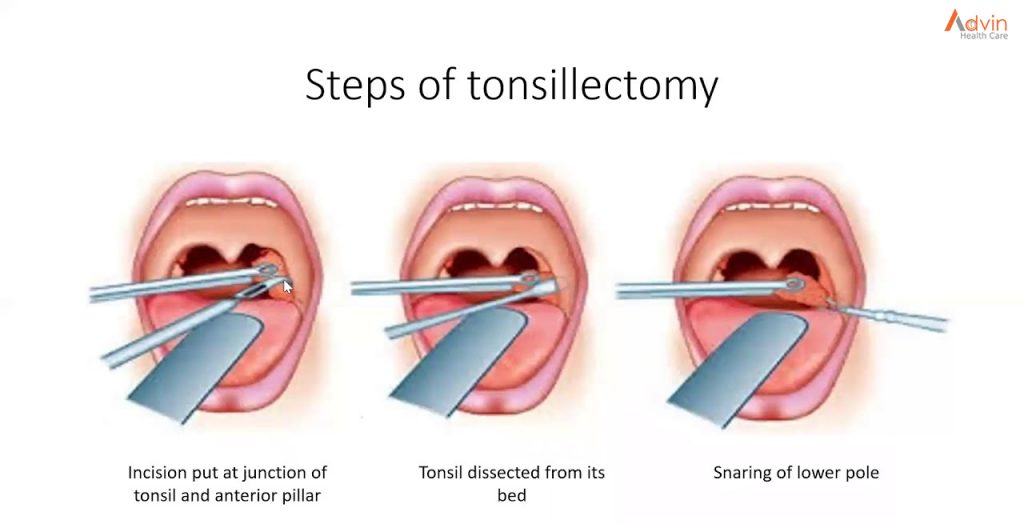 tonsillectomy procedure step by step