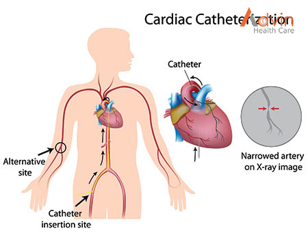 Heart Attack and Sudden Cardiac Arrest Differences – AdvinHealthcare %