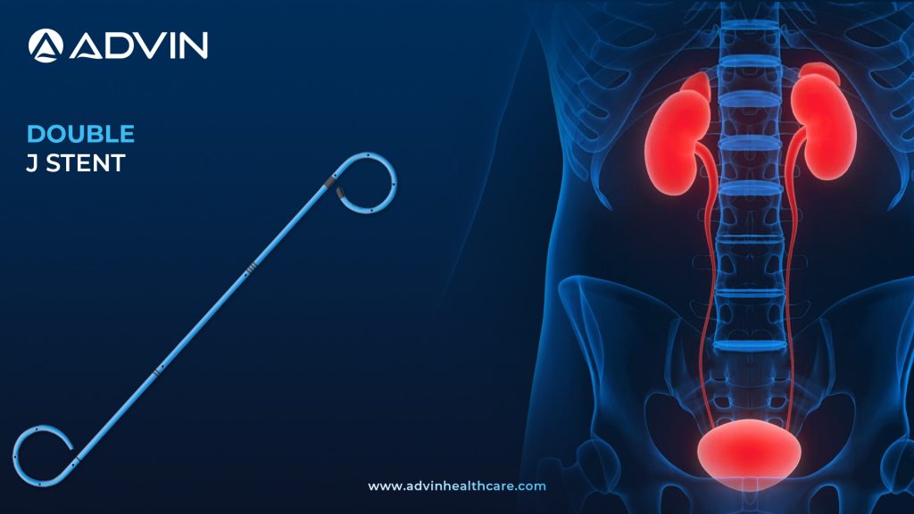 Double J Stent – Reliable Support for Ureteral Patency