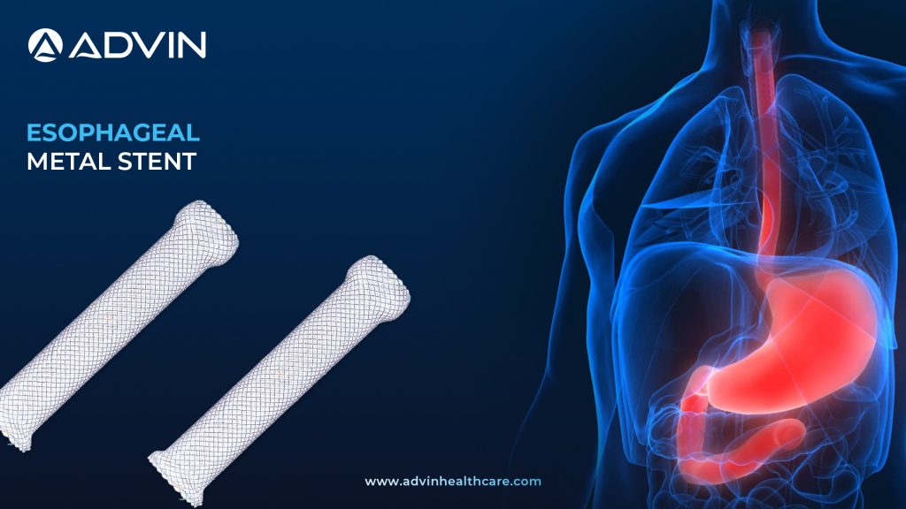 Esophageal Metal Stents – Restoring Swallowing and Enhancing Patient Care