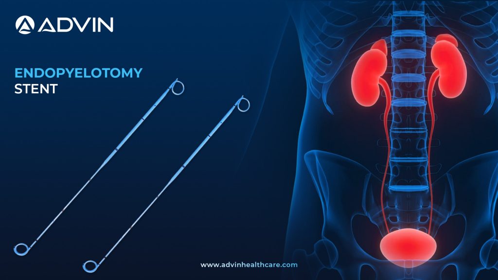 Endopyelotomy Stent – Specialized Support for Ureteropelvic Junction (UPJ) Repair