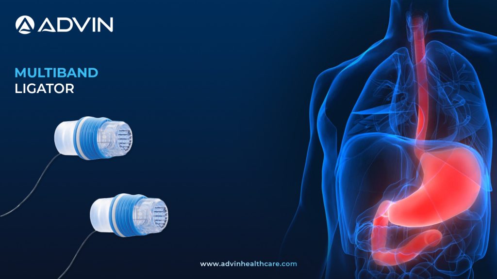 Multiband Ligator – Efficient and Reliable Variceal Ligation in GI Endoscopy