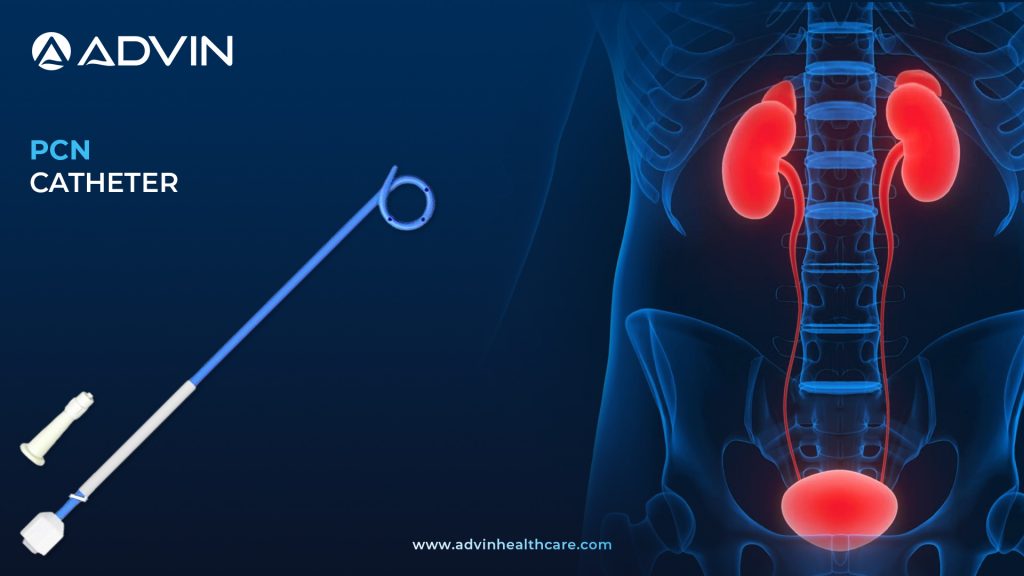 PCN Catheter – Essential for Kidney Drainage in Obstructive Uropathy
