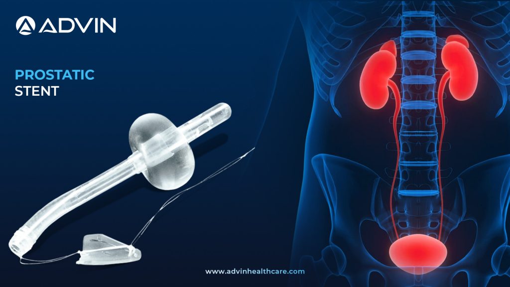 Prostatic Stent – Minimally Invasive Relief for BPH and Urinary Obstruction