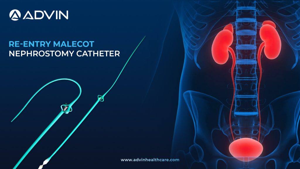 Re-Entry Malecot Nephrostomy Catheter – Reliable Drainage with Easy Tract Re-Access