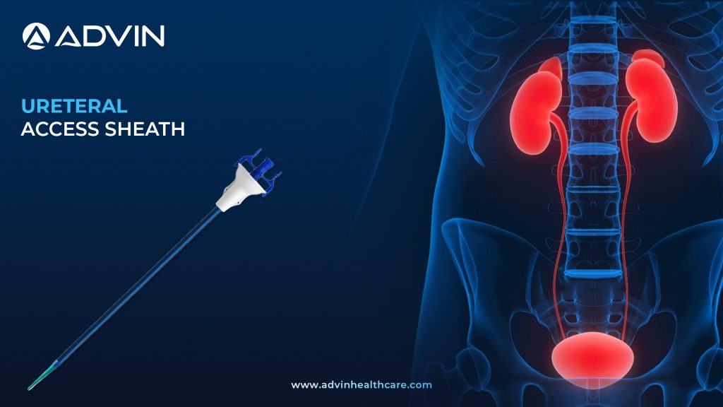 Ureteral Access Sheath – Smooth and Safe Access for Urological Procedures
