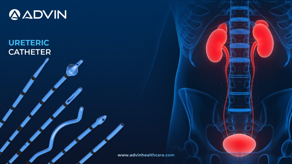 Ureteric Catheter – Essential Tool for Temporary Ureteral Drainage and Access