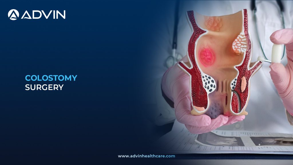 Colostomy Surgery – Effective Treatment for Severe Intestinal Conditions