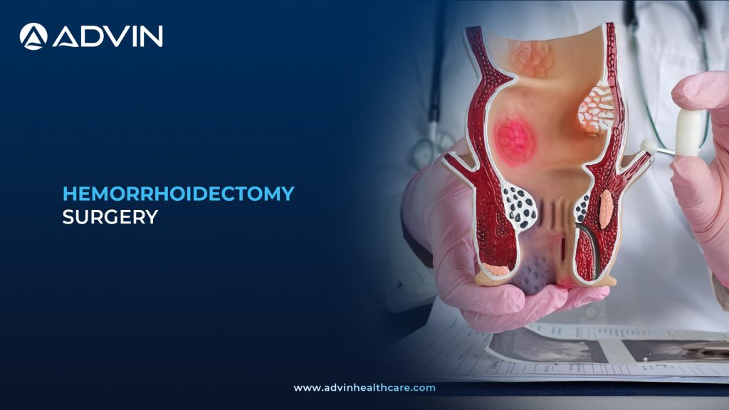 A Surgical Solution for Hemorrhoids – All About Hemorrhoidectomy