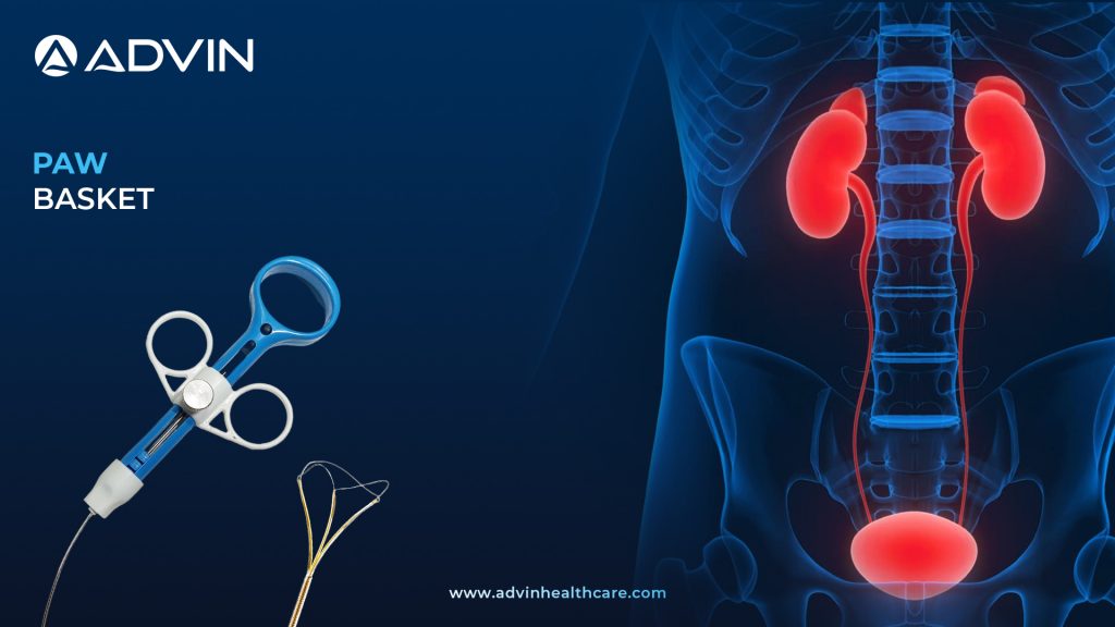 Paw Basket – Efficient Stone Retrieval Solution in Urological Procedures