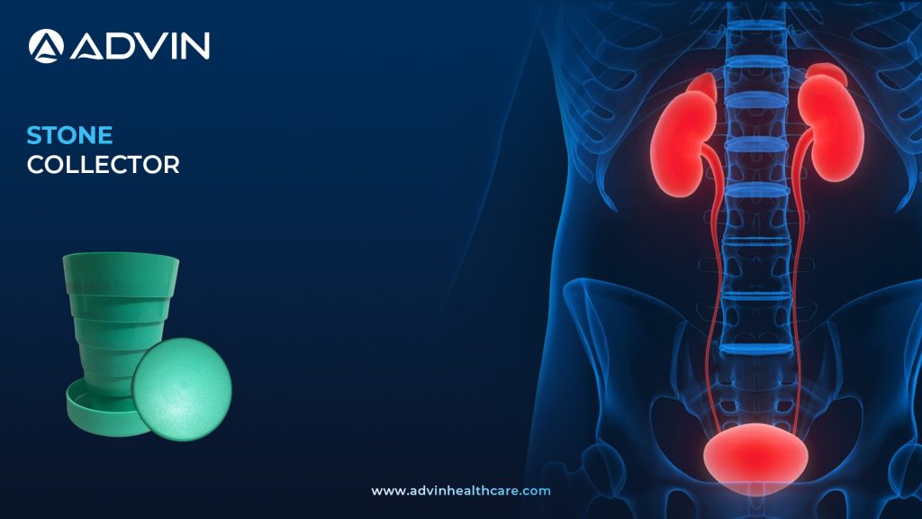 Stone Collector – Essential Device for Safe Stone Retrieval in Urology