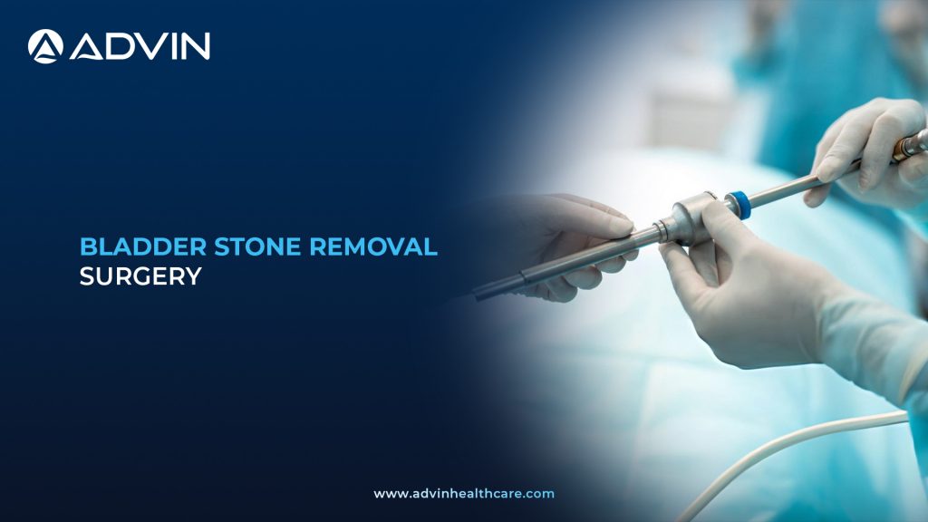 Bladder Stone Removal Surgery – Modern Surgical Approach for Restoring Bladder Health.