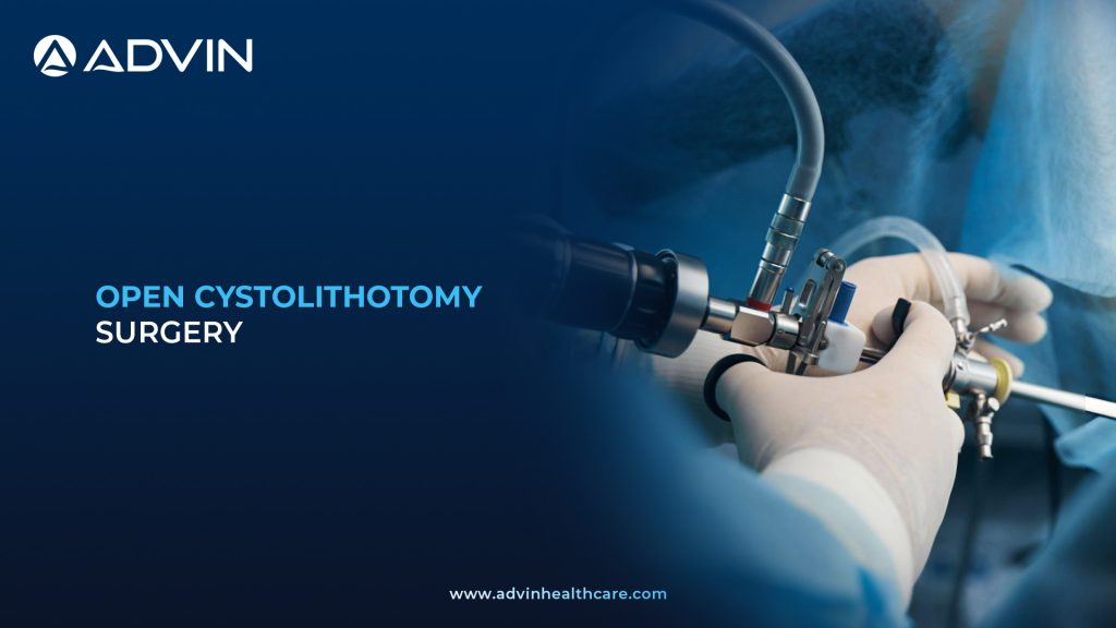 Open Cystolithotomy Surgery – Direct Surgical Solution for Large and Complex Bladder Stones.