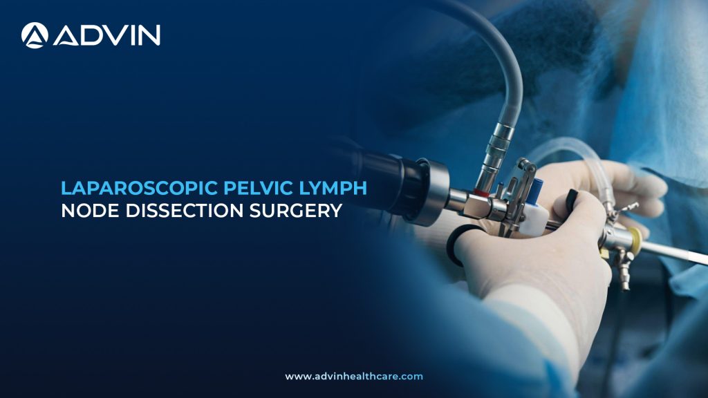 Laparoscopic Pelvic Lymph Node Dissection Surgery – Advanced Endoscopic Technique for Precise Nodal Removal